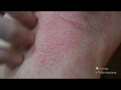 Dermatiti da stress immagini